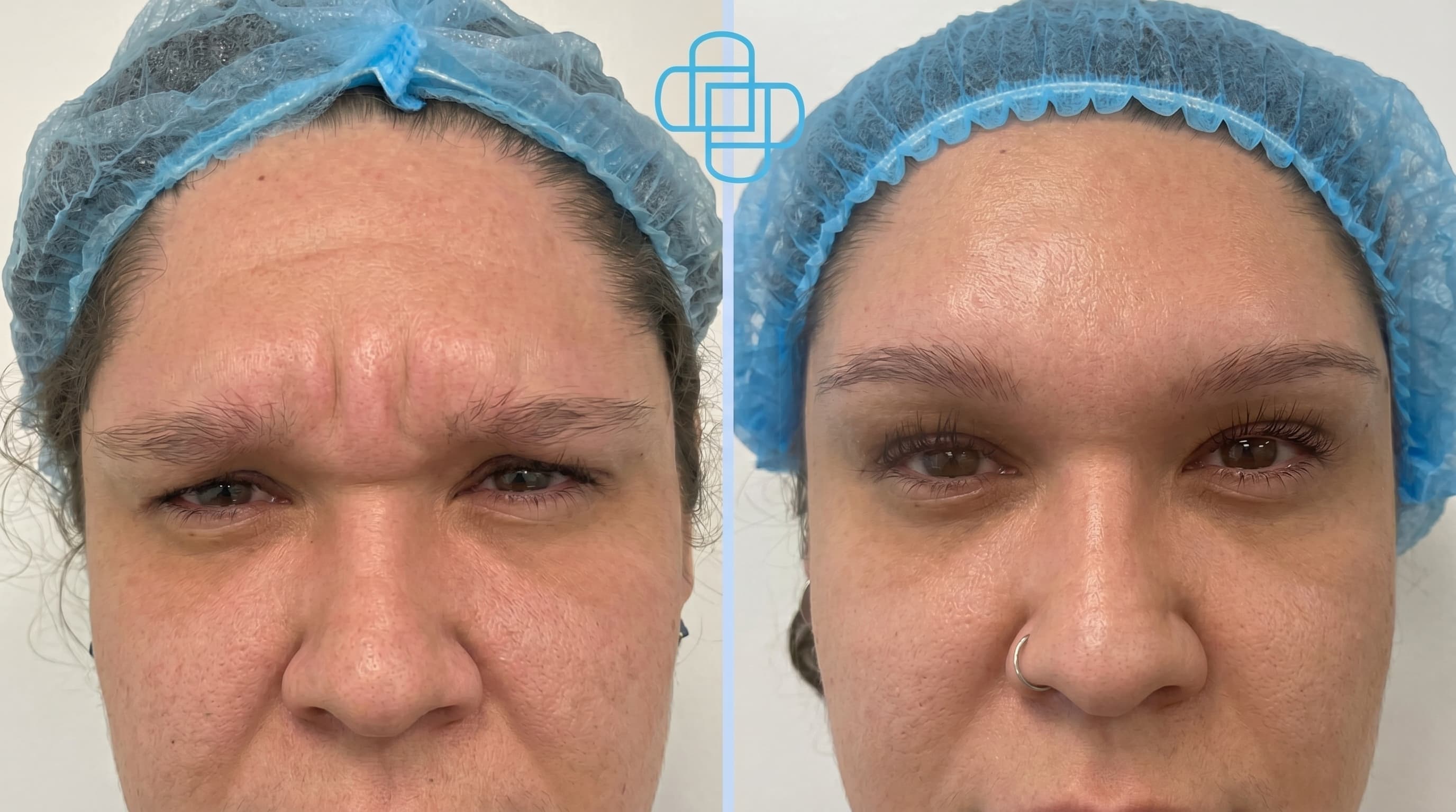 Toxina Botulínica en Entrecejo