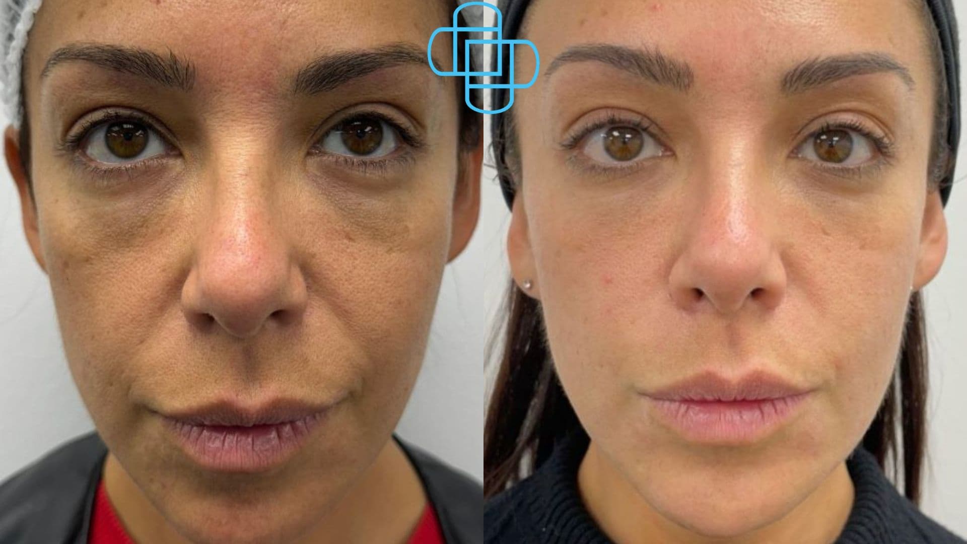 Antes y después: Sculptra y Relleno de Pómulos con Ácido Hialurónico